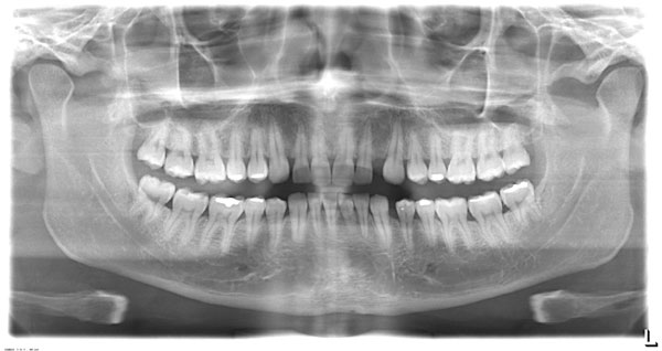 P.A. de Mandíbula - Unimagem Radiografia Odontológica Curitiba